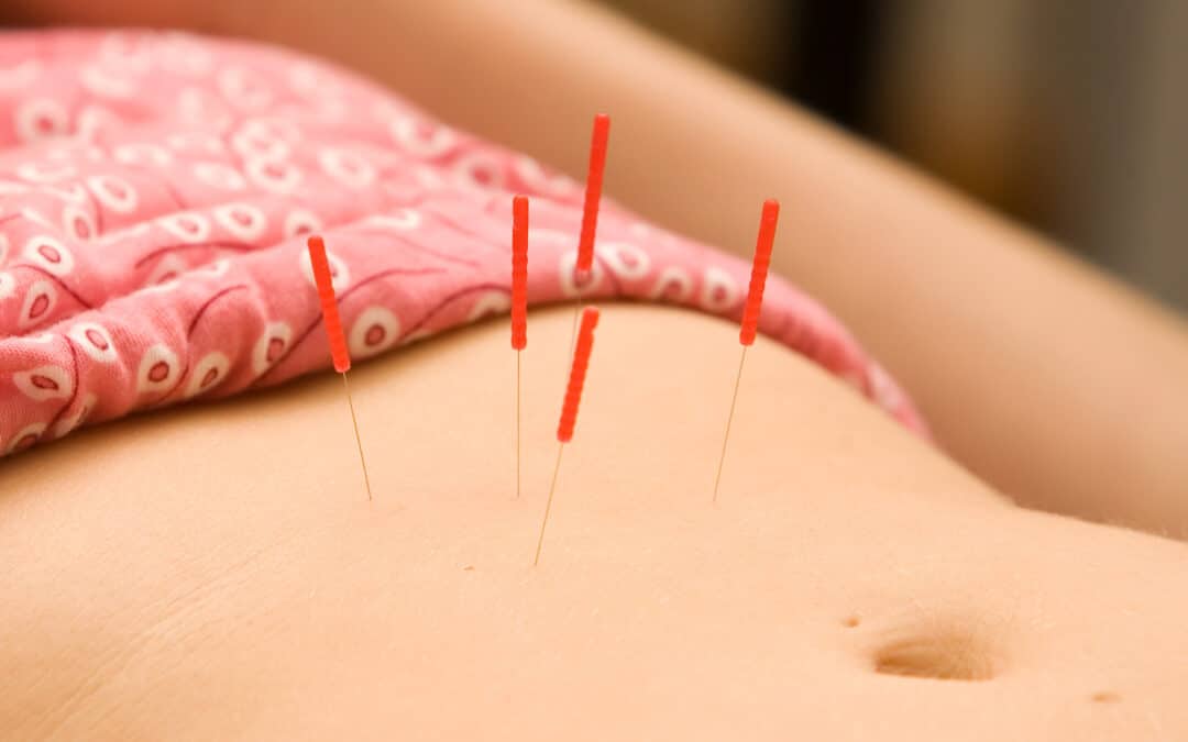 Can Acupuncture Help Reduce Anxiety and Stress?